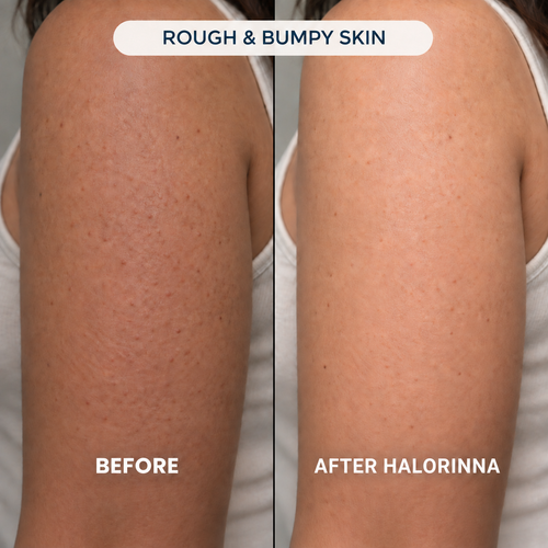 Side-by-side arm photos labeled Before and After Halorinna for rough and bumpy skin