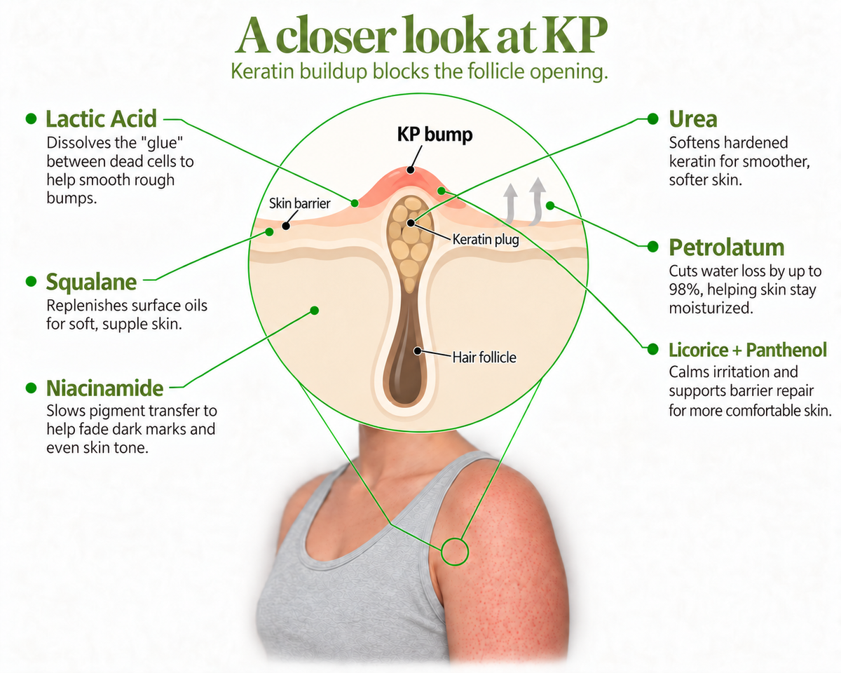 A closer look at KP: simplified illustration of a blocked hair follicle with a red KP bump, labeled skin barrier and keratin plug, six ingredient benefits, and a shoulder with KP.